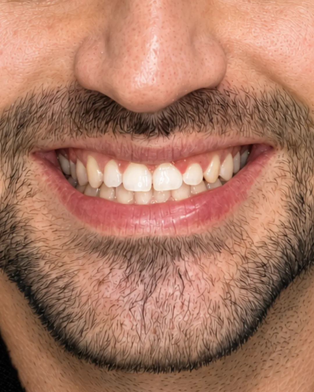 Sorriso antes do tratamento odontológico estético na White Lounge, em Florianópolis