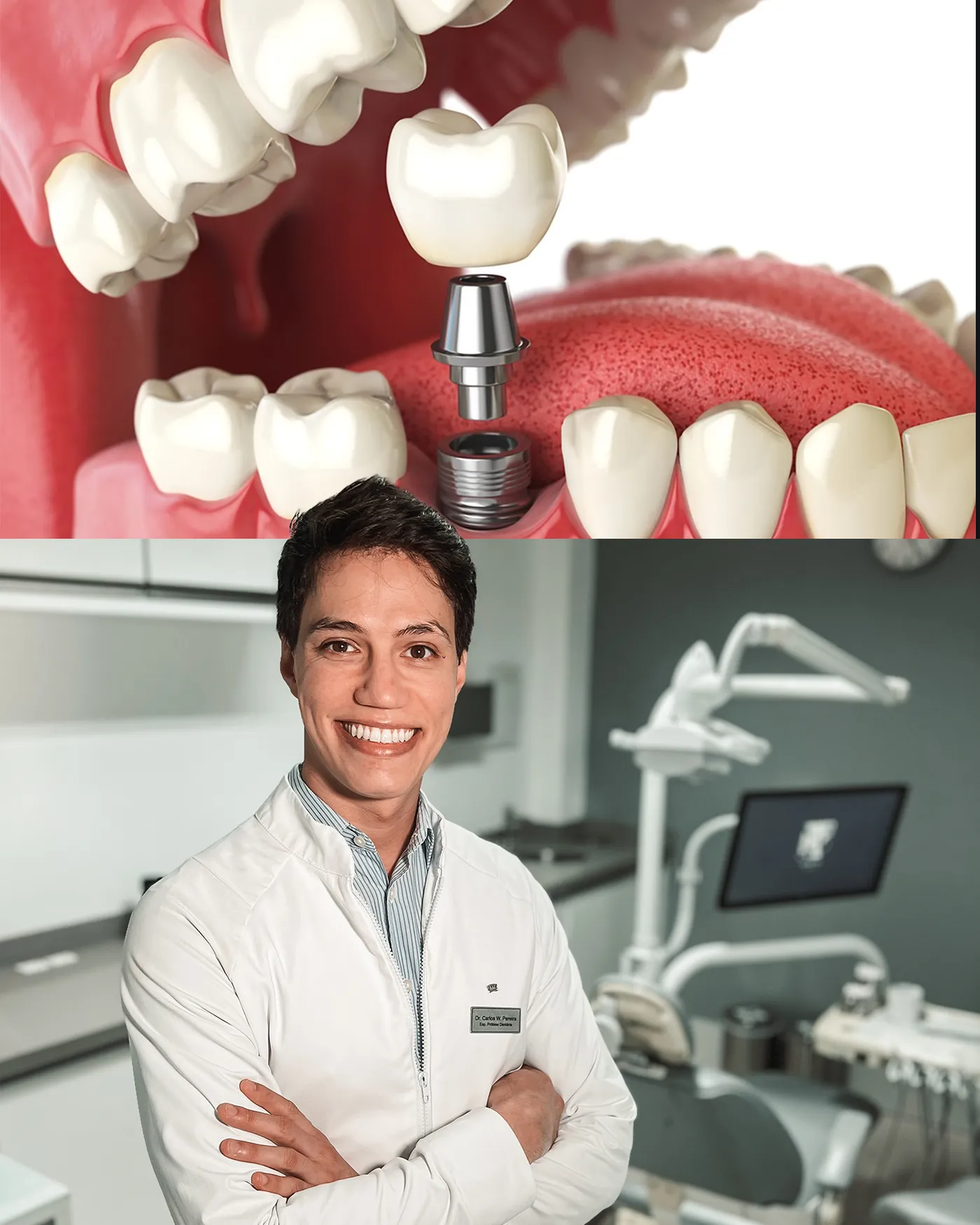 Implante dentário com pilar e coroa de porcelana ao lado do Dr. Carlos Willian Pereira, implantodontista na White Lounge em Florianópolis